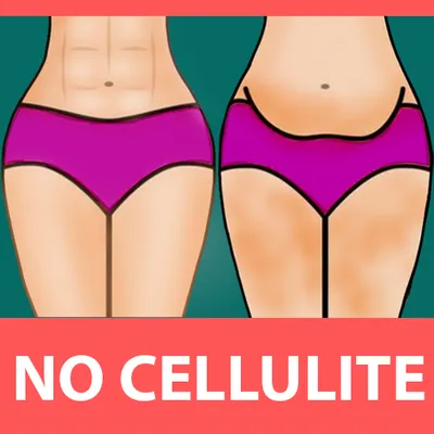 Cellulite removal -buttocks workout